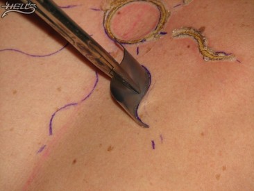 Při brandingu jizva vzniká po spálení kůže rožhaveným plíškem, Zdro: Hell.cz