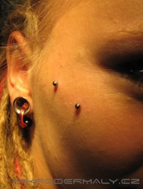 Mikrodermály umístěné tak, aby působily jako surface, Zdroj: www.mikrodermaly.cz