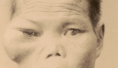 FOTO: Lékařské fotografie z Japonka kolem roku 1900