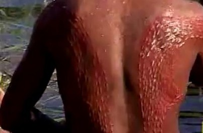 FOTO: Jizvy připomínající krokodýlí kůži