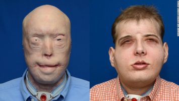 Patrick Hardinson transplantace obličeje