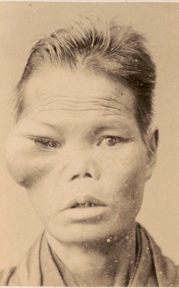 FOTO: Lékařské fotografie z Japonka kolem roku 1900