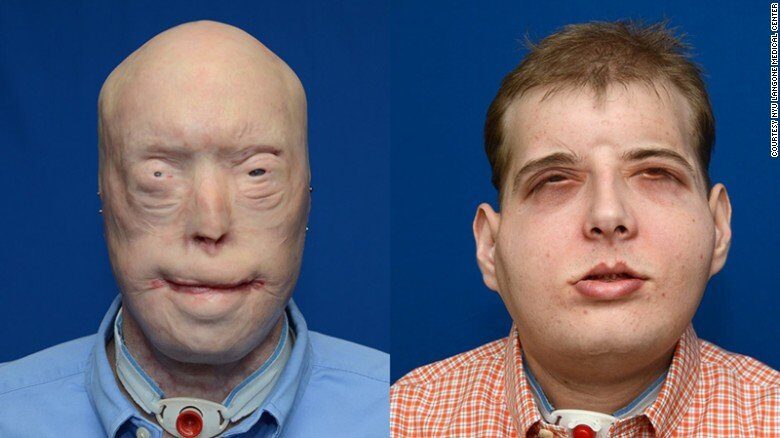 Patrick Hardinson transplantace obličeje