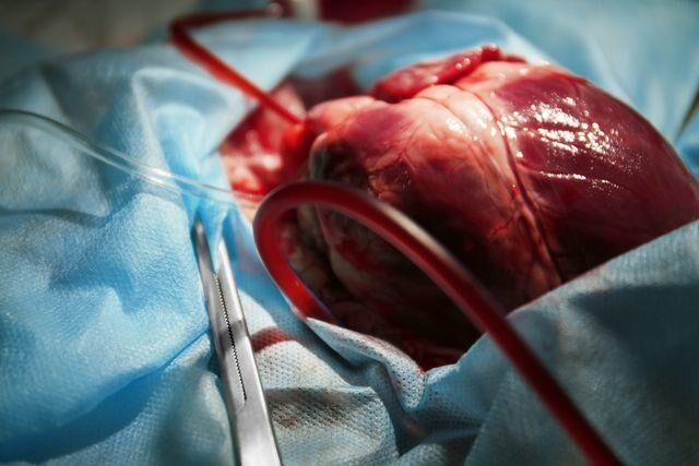 transplantace-srdce