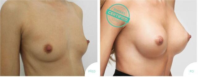 Zvětšení augmentace prsou Brandeis Clinic