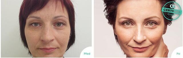 Operace nosu, Brandeis Clinic