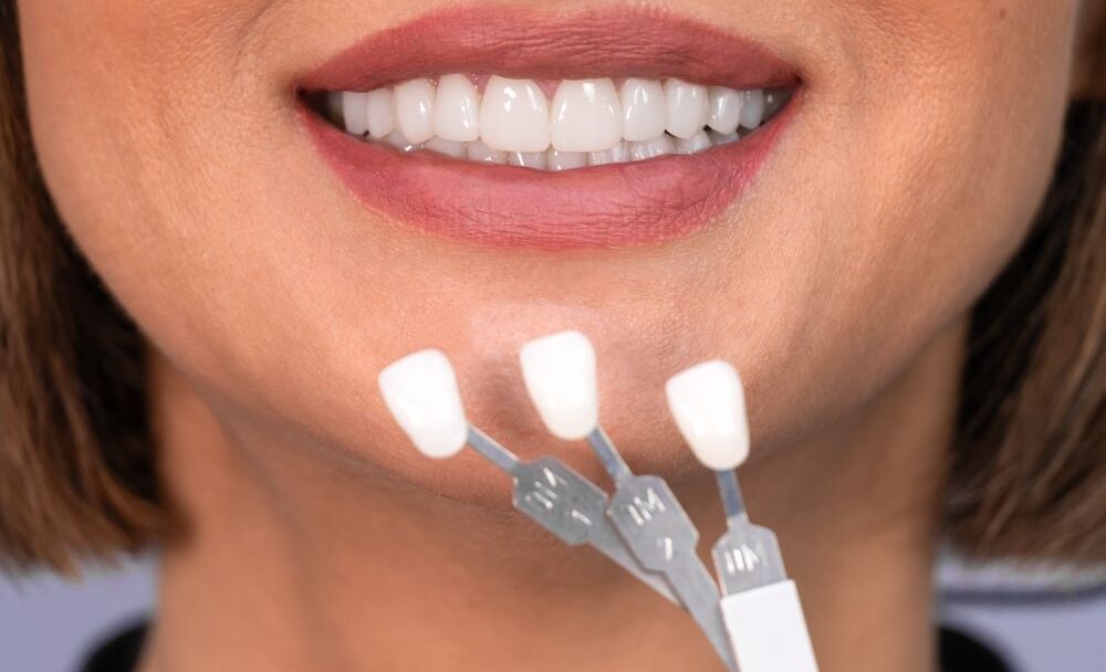 Jak vybrat zubní fazety