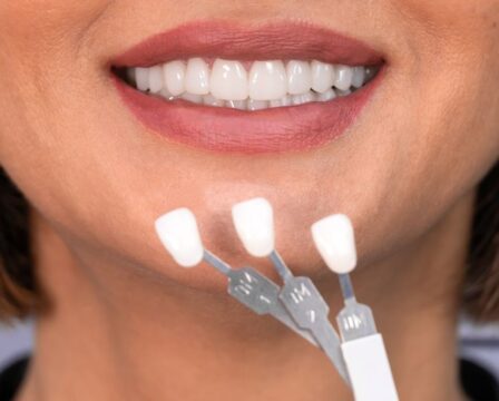 Jak vybrat zubní fazety